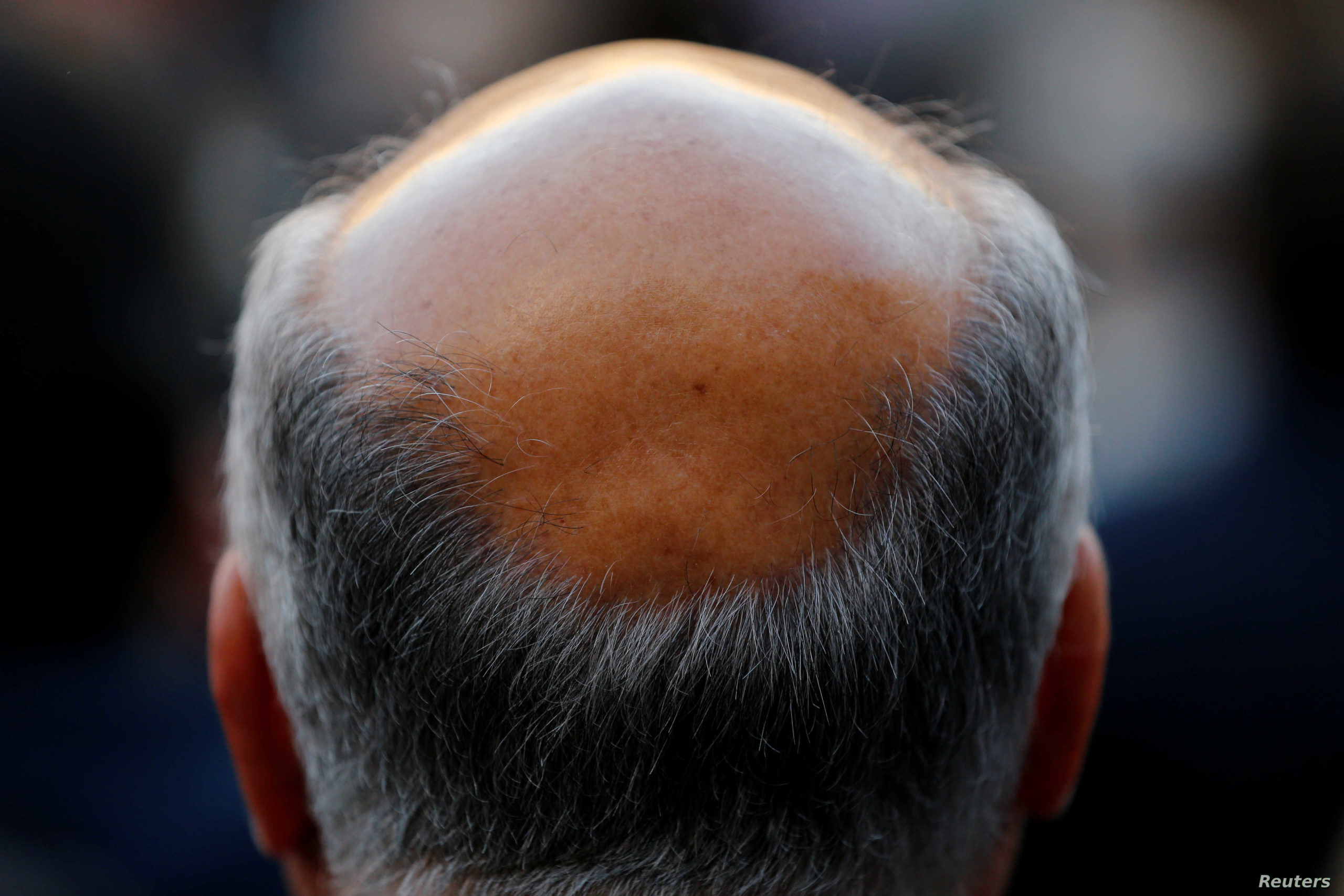 man with baldness
